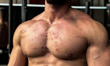 Acne on the chest due to steroid cycles