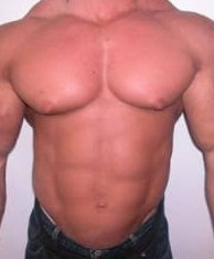 Steroid gynecomastia