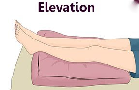 Muscle elevation in the RICE method